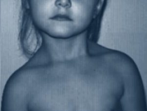 Przykład kręczu szyi u dziecka